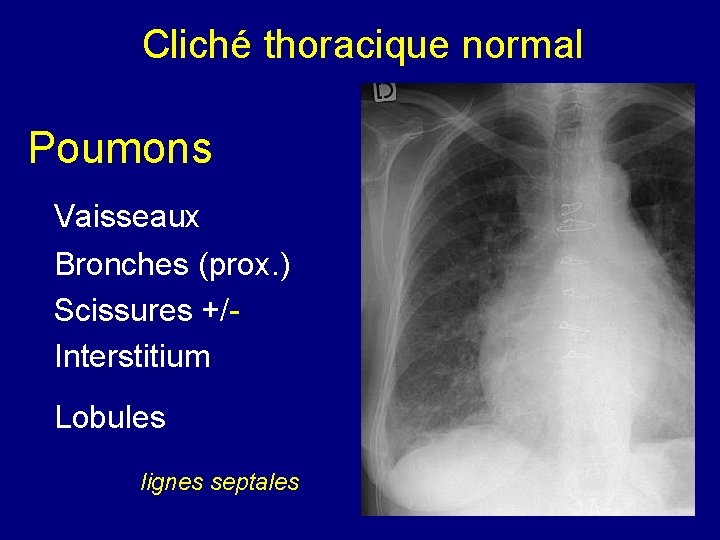 Cliché thoracique normal Poumons Vaisseaux Bronches (prox. ) Scissures +/Interstitium Lobules lignes septales 