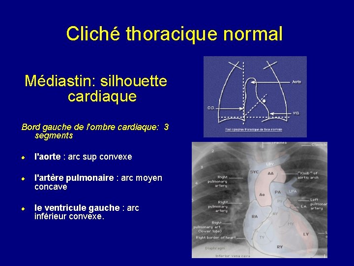 Cliché thoracique normal Médiastin: silhouette cardiaque Bord gauche de l'ombre cardiaque: 3 segments l'aorte