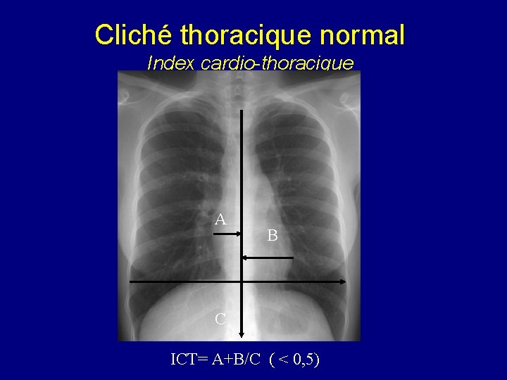 Cliché thoracique normal Index cardio-thoracique A B C ICT= A+B/C ( < 0, 5)