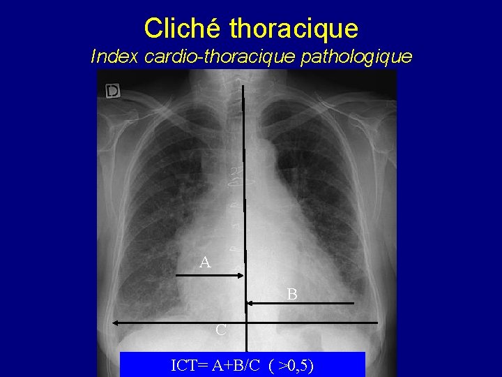 Cliché thoracique Index cardio-thoracique pathologique A B C ICT= A+B/C ( >0, 5) 