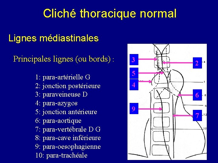 Cliché thoracique normal Lignes médiastinales Principales lignes (ou bords) : 1: para-artérielle G 2: