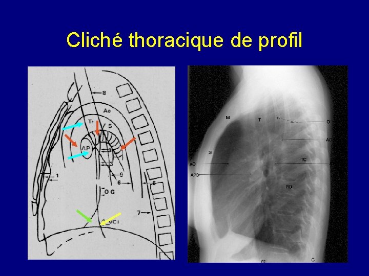 Cliché thoracique de profil 