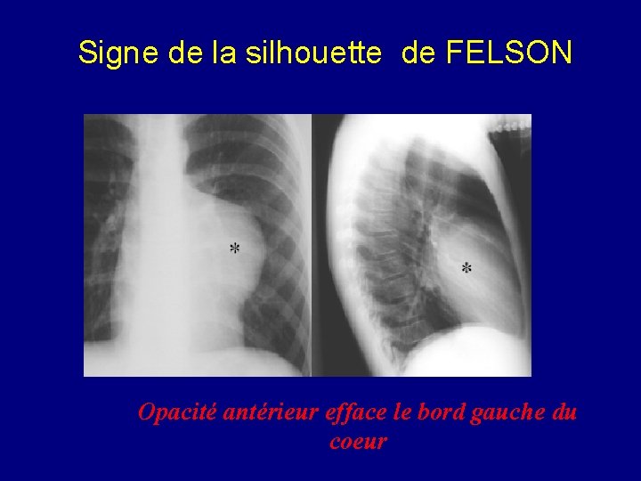 Signe de la silhouette de FELSON Opacité antérieur efface le bord gauche du coeur