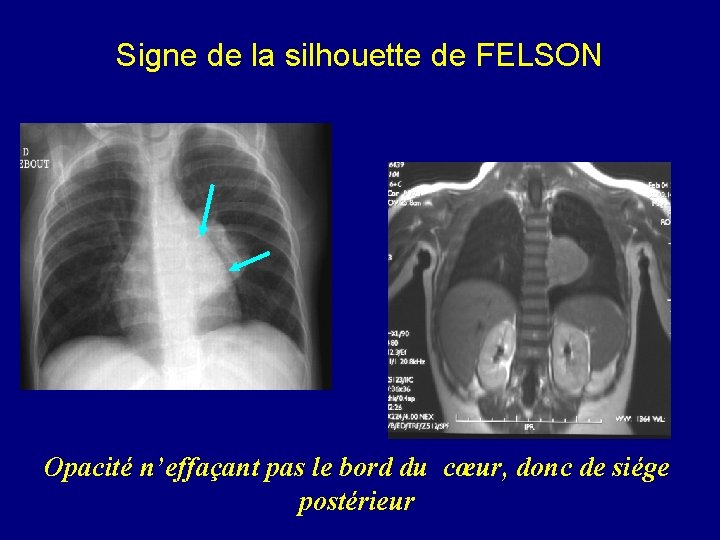 Signe de la silhouette de FELSON Opacité n’effaçant pas le bord du cœur, donc