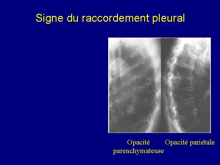 Signe du raccordement pleural Opacité pariétale parenchymateuse 