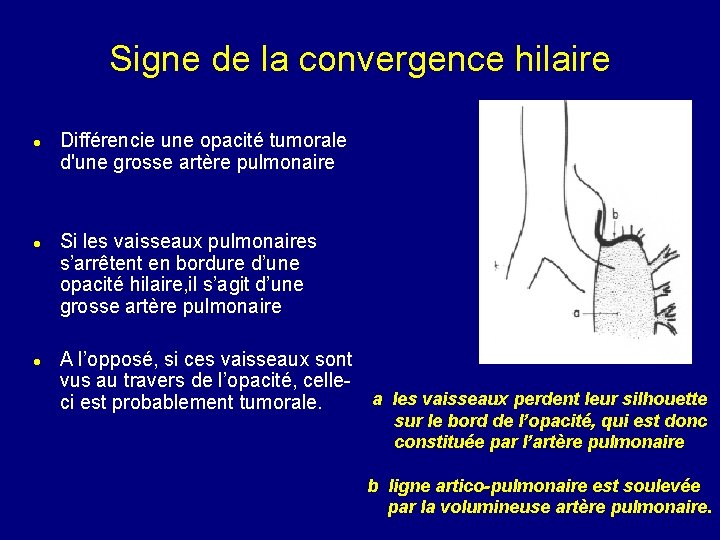 Signe de la convergence hilaire Différencie une opacité tumorale d'une grosse artère pulmonaire Si