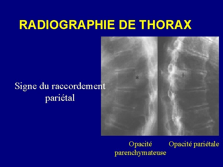 RADIOGRAPHIE DE THORAX Signe du raccordement pariétal Opacité pariétale parenchymateuse 