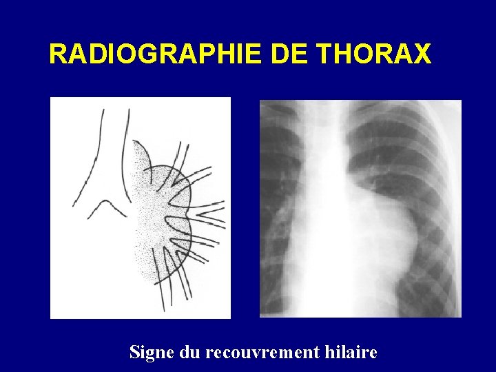 RADIOGRAPHIE DE THORAX Signe du recouvrement hilaire 