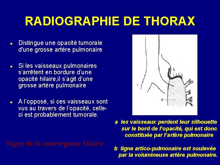 RADIOGRAPHIE DE THORAX Distingue une opacité tumorale d'une grosse artère pulmonaire Si les vaisseaux