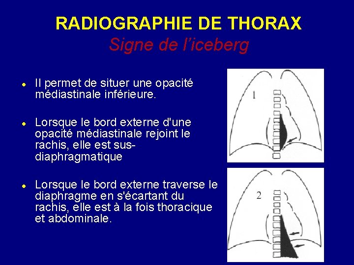 RADIOGRAPHIE DE THORAX Signe de l’iceberg Il permet de situer une opacité médiastinale inférieure.