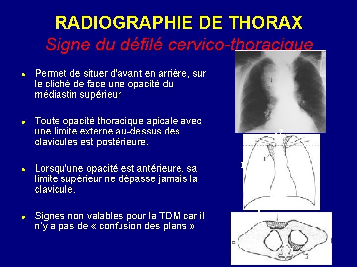 RADIOGRAPHIE DE THORAX Signe du défilé cervico-thoracique Permet de situer d'avant en arrière, sur