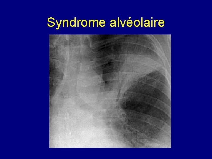 Syndrome alvéolaire 