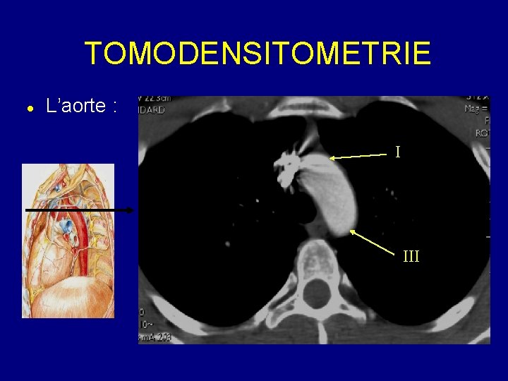 TOMODENSITOMETRIE L’aorte : I III 