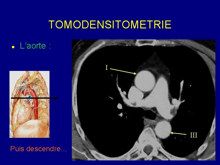 TOMODENSITOMETRIE L’aorte : I III Puis descendre… 