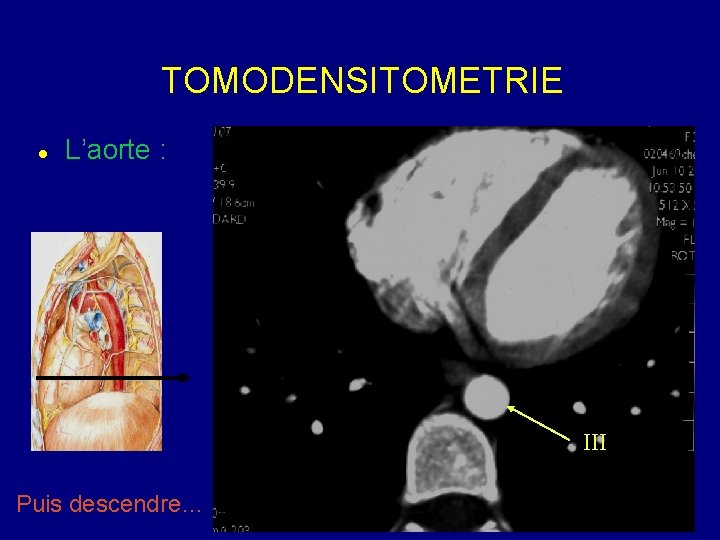 TOMODENSITOMETRIE L’aorte : III Puis descendre… 