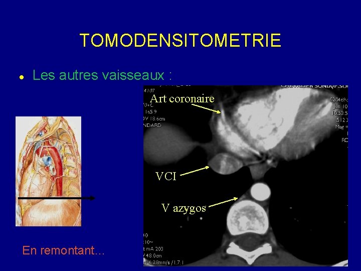 TOMODENSITOMETRIE Les autres vaisseaux : Art coronaire VCI V azygos En remontant… 