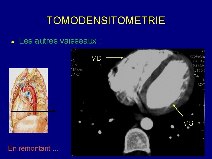 TOMODENSITOMETRIE Les autres vaisseaux : VD VG En remontant … 