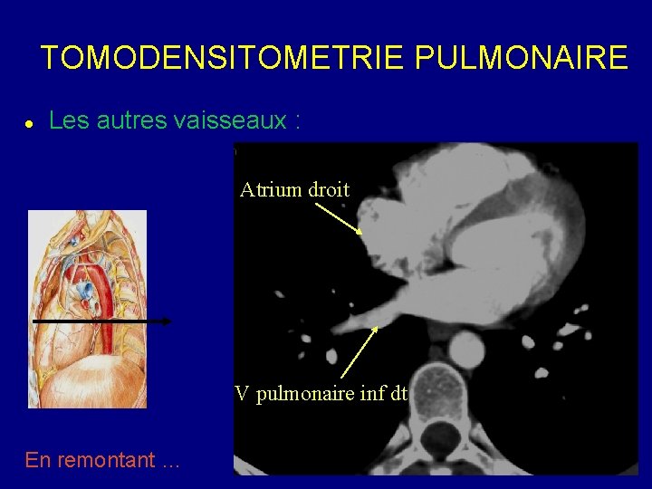 TOMODENSITOMETRIE PULMONAIRE Les autres vaisseaux : Atrium droit V pulmonaire inf dt En remontant