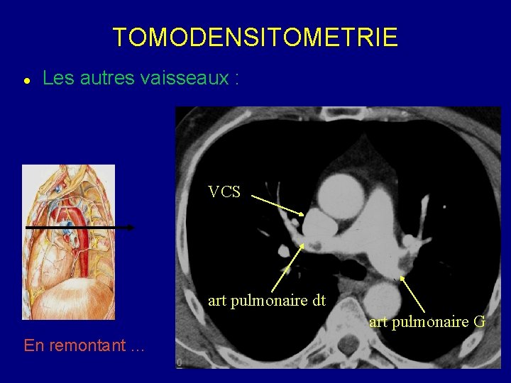 TOMODENSITOMETRIE Les autres vaisseaux : VCS art pulmonaire dt art pulmonaire G En remontant