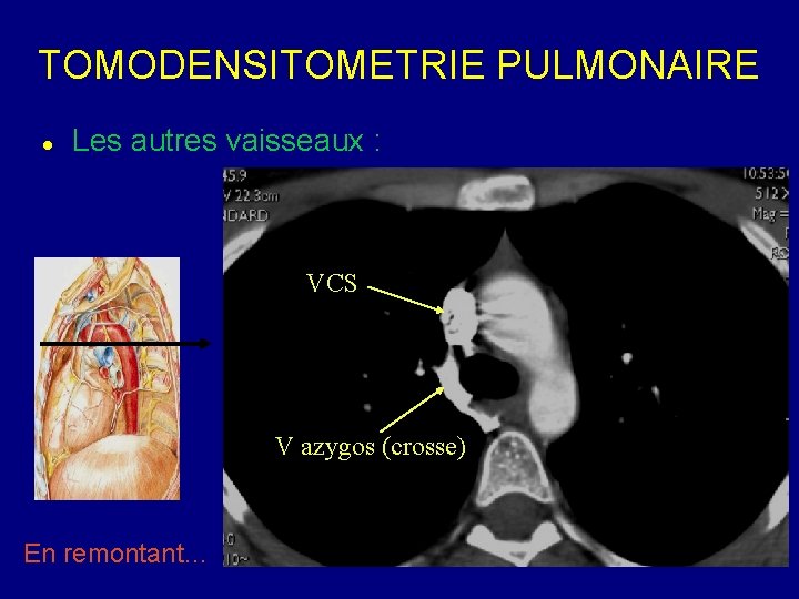 TOMODENSITOMETRIE PULMONAIRE Les autres vaisseaux : VCS V azygos (crosse) En remontant… 