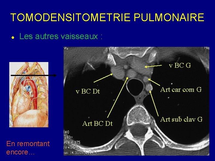 TOMODENSITOMETRIE PULMONAIRE Les autres vaisseaux : v BC G v BC Dt Art BC