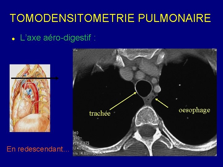 TOMODENSITOMETRIE PULMONAIRE L’axe aéro-digestif : trachée En redescendant… oesophage 