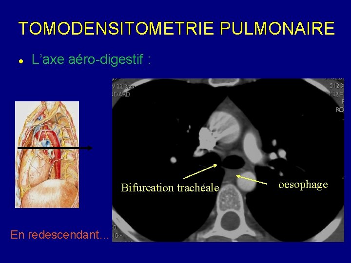 TOMODENSITOMETRIE PULMONAIRE L’axe aéro-digestif : Bifurcation trachéale En redescendant… oesophage 