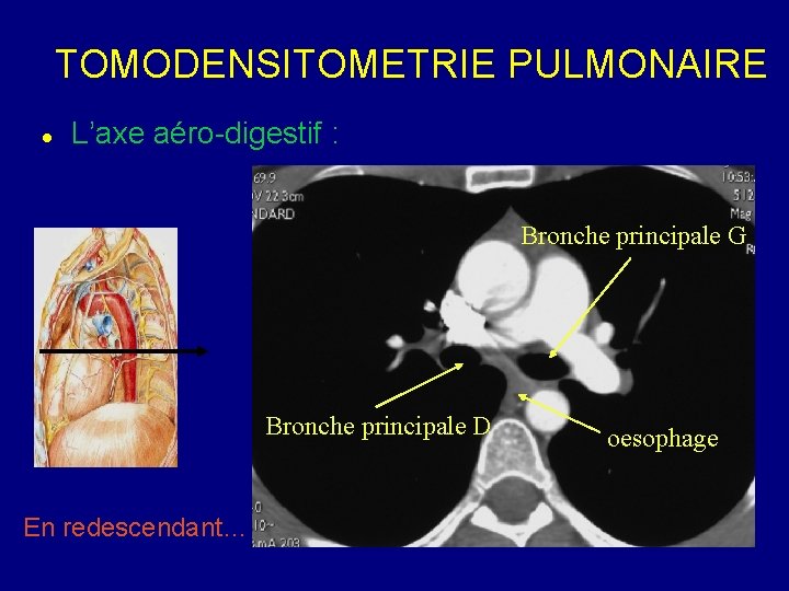TOMODENSITOMETRIE PULMONAIRE L’axe aéro-digestif : Bronche principale G Bronche principale D En redescendant… oesophage