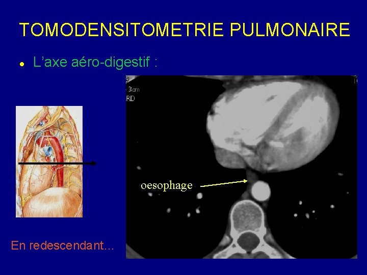 TOMODENSITOMETRIE PULMONAIRE L’axe aéro-digestif : oesophage En redescendant… 
