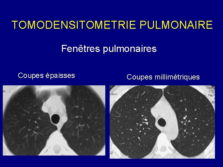 TOMODENSITOMETRIE PULMONAIRE Fenêtres pulmonaires Coupes épaisses Coupes millimétriques 