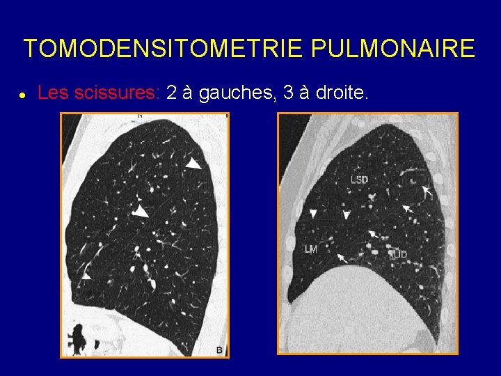 TOMODENSITOMETRIE PULMONAIRE Les scissures: 2 à gauches, 3 à droite. 