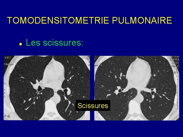 TOMODENSITOMETRIE PULMONAIRE Les scissures: Scissures 