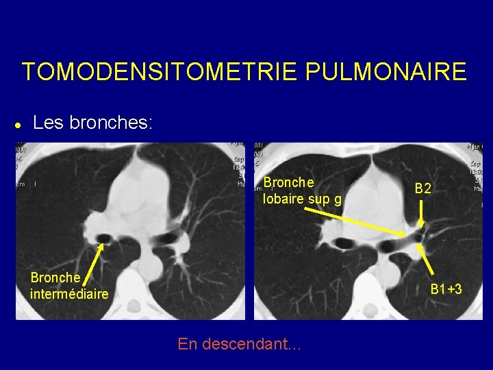 TOMODENSITOMETRIE PULMONAIRE Les bronches: Bronche lobaire sup g Bronche intermédiaire B 2 B 1+3