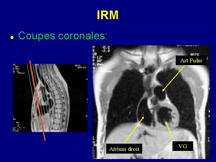 IRM Coupes coronales: Art Pulm Atrium droit VG 