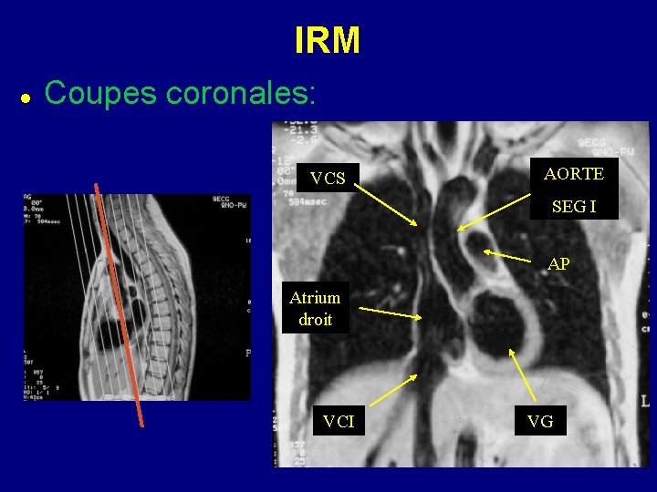 IRM Coupes coronales: VCS AORTE SEG I AP Atrium droit VCI VG 