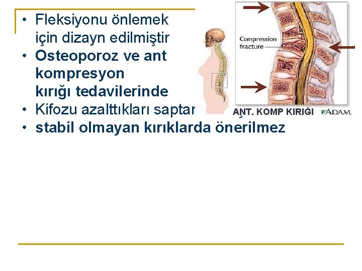 • Fleksiyonu önlemek için dizayn edilmiştir • Osteoporoz ve ant kompresyon kırığı tedavilerinde • Fleksiyonu önlemek için dizayn edilmiştir • Osteoporoz ve ant kompresyon kırığı tedavilerinde