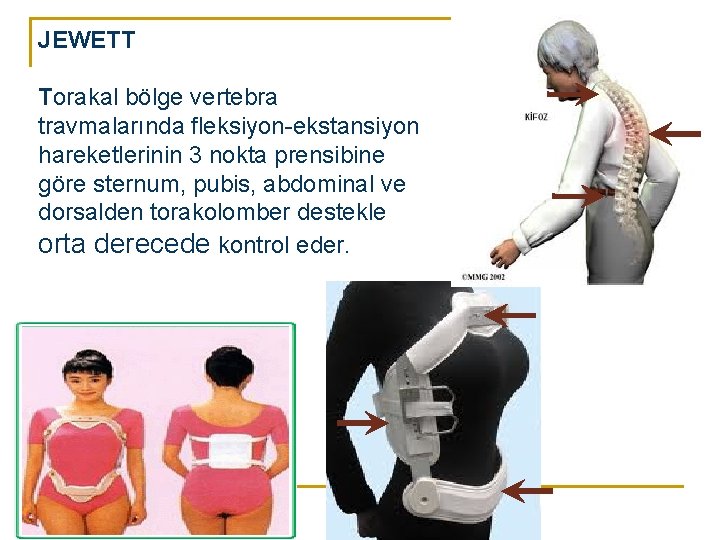 JEWETT Torakal bölge vertebra travmalarında fleksiyon-ekstansiyon hareketlerinin 3 nokta prensibine göre sternum, pubis, abdominal JEWETT Torakal bölge vertebra travmalarında fleksiyon-ekstansiyon hareketlerinin 3 nokta prensibine göre sternum, pubis, abdominal