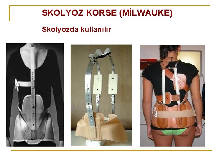 SKOLYOZ KORSE (MİLWAUKE) Skolyozda kullanılır SKOLYOZ KORSE (MİLWAUKE) Skolyozda kullanılır