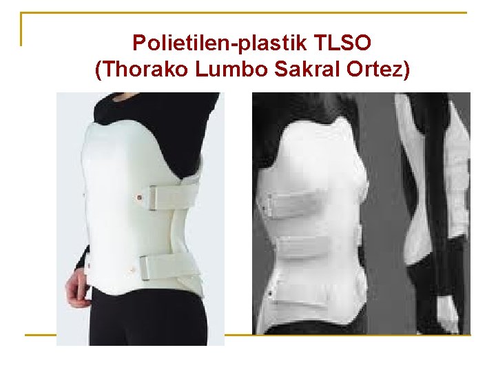 Polietilen-plastik TLSO (Thorako Lumbo Sakral Ortez) Polietilen-plastik TLSO (Thorako Lumbo Sakral Ortez)