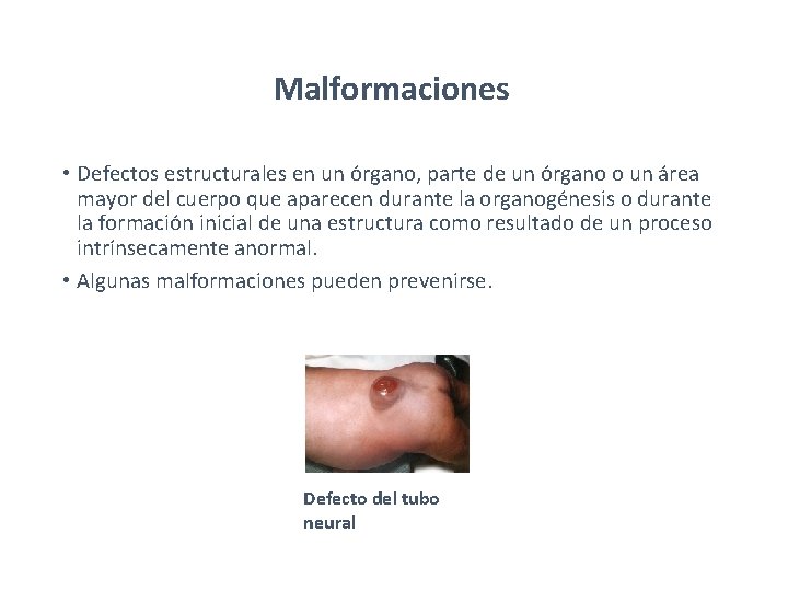 Malformaciones • Defectos estructurales en un órgano, parte de un órgano o un área Malformaciones • Defectos estructurales en un órgano, parte de un órgano o un área