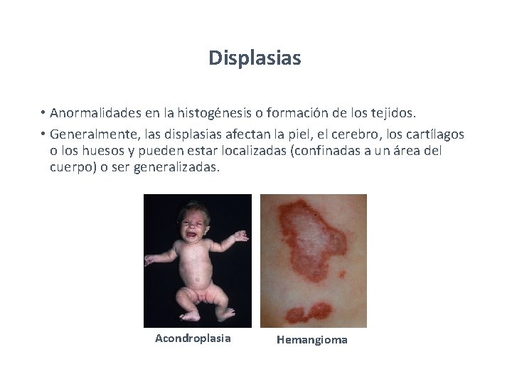 Displasias • Anormalidades en la histogénesis o formación de los tejidos. • Generalmente, las Displasias • Anormalidades en la histogénesis o formación de los tejidos. • Generalmente, las