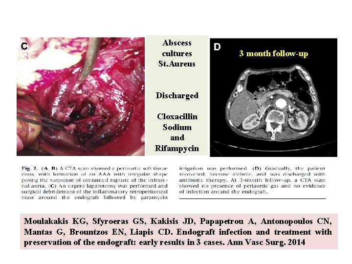 Abscess cultures St. Aureus 3 month follow-up Discharged Cloxacillin Sodium and Rifampycin Moulakakis KG,