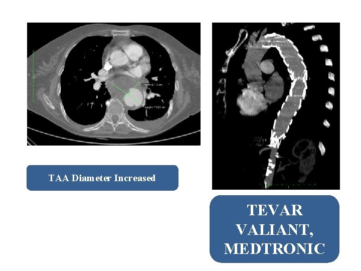 TAA Diameter Increased TEVAR VALIANT, MEDTRONIC 