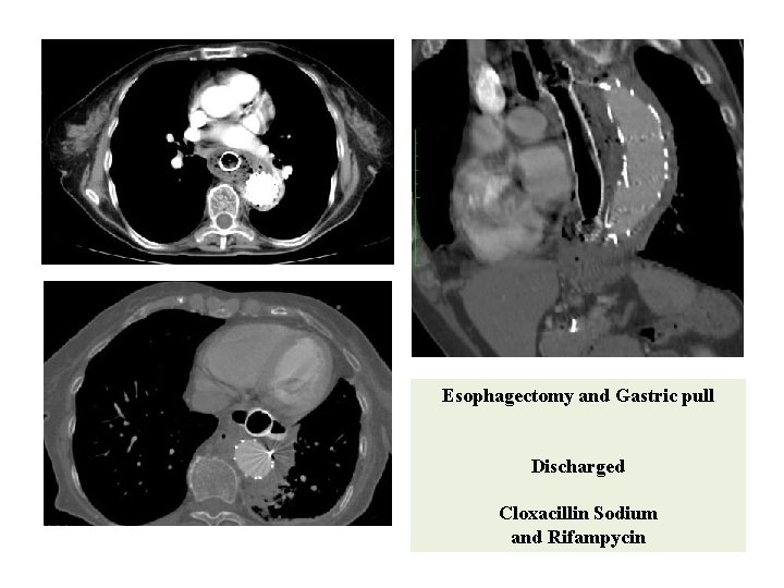 Esophagectomy and Gastric pull Discharged Cloxacillin Sodium and Rifampycin 