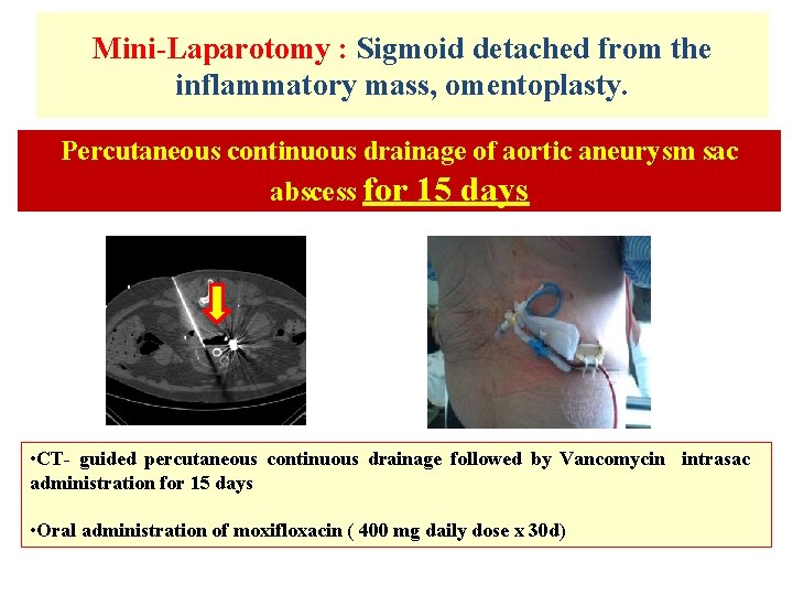 Mini-Laparotomy : Sigmoid detached from the inflammatory mass, omentoplasty. Percutaneous continuous drainage of aortic