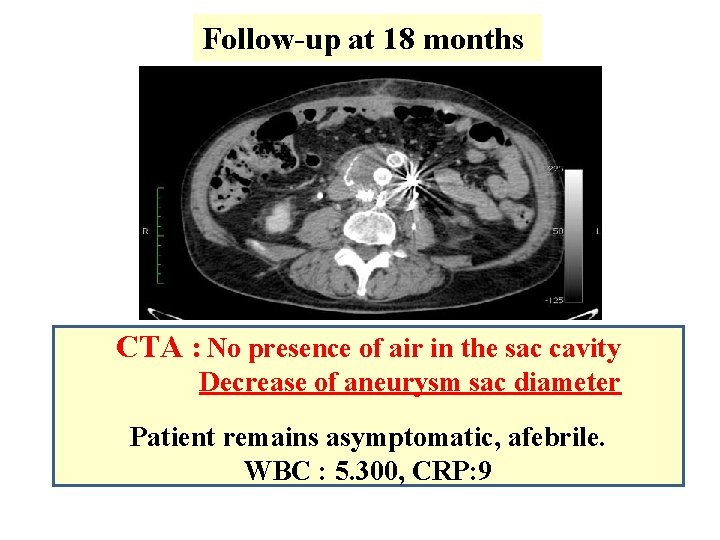 Follow-up at 18 months CTA : No presence of air in the sac cavity