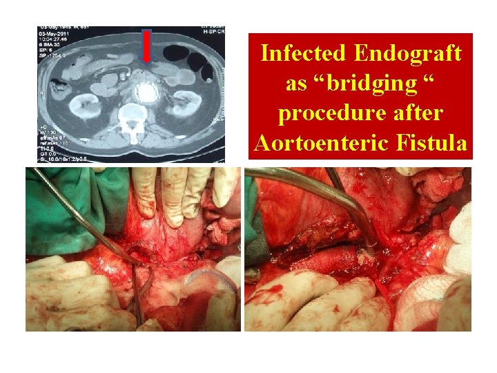 Infected Endograft as “bridging “ procedure after Aortoenteric Fistula 