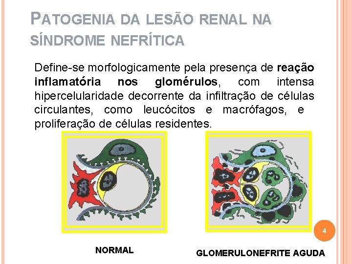 PATOGENIA DA LESÃO RENAL NA SÍNDROME NEFRÍTICA Define-se morfologicamente pela presença de reação inflamatória