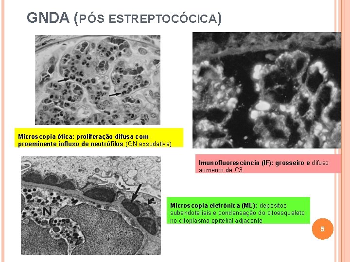 GNDA (P ÓS ESTREPTOCÓCICA) Microscopia ótica: proliferação difusa com proeminente influxo de neutrófilos (GN