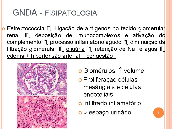 GNDA - FISIPATOLOGIA Estreptococcia Ligação de antígenos no tecido glomerular renal deposição de imunocomplexos